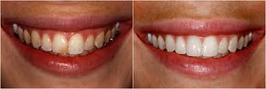 Simple Teeth-Whitening Solutions